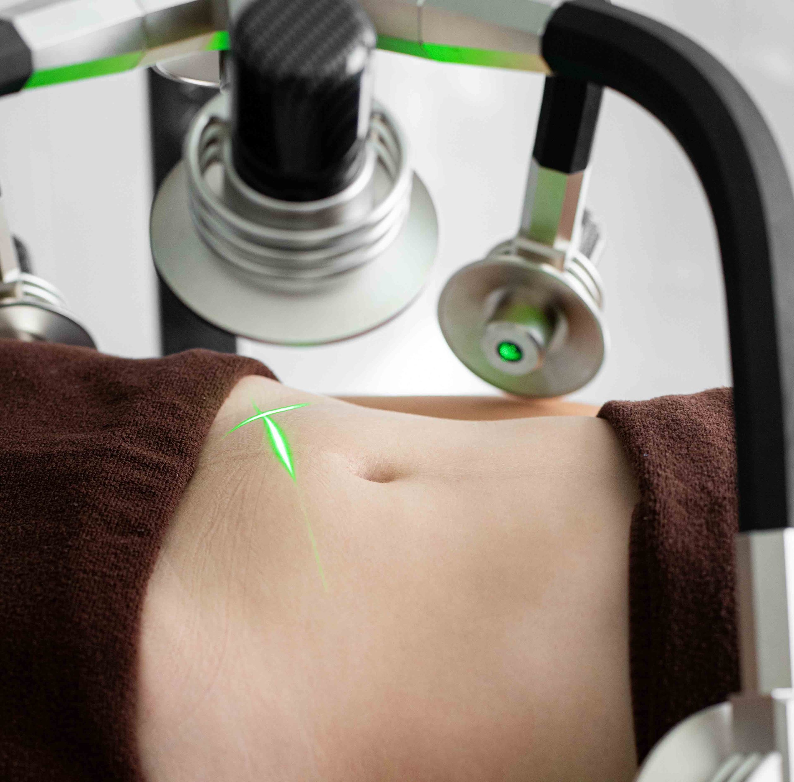 Radiofrequency Fat Loss Treatment - BioRestore Health