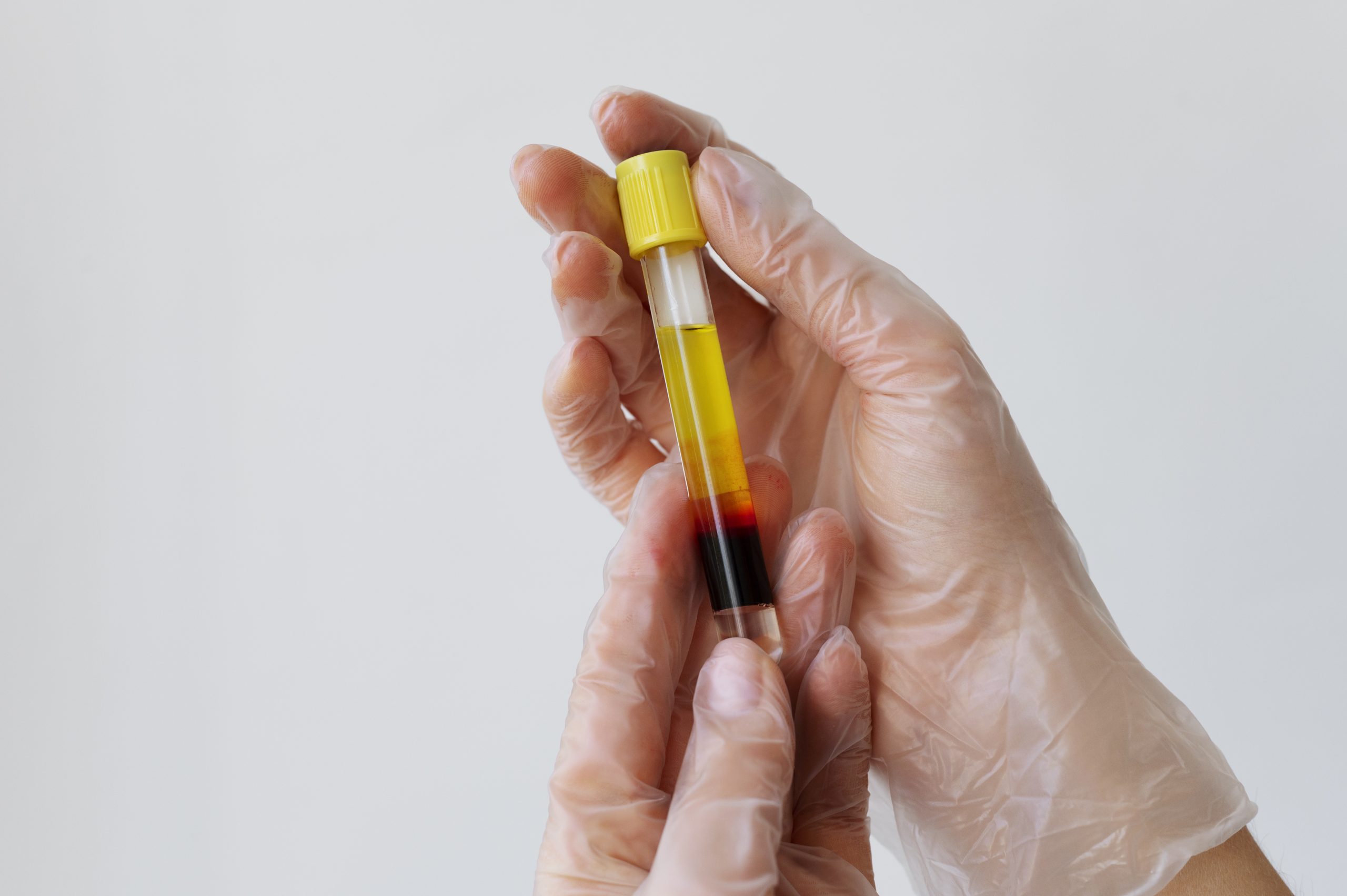 hands-holding-vial-prp-treatments-close-up-1-scaled.jpg
