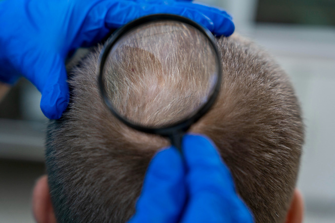 5 Mistakes To Avoid When Choosing a Hair Loss Clinic