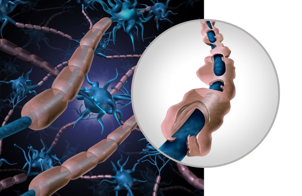 How to Prepare for Stem Cell Therapy for Multiple Sclerosis