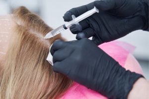 Exosomes Injection for Hair Loss