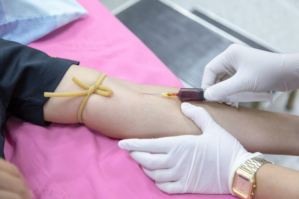 PRP Injection Process: Step by Step