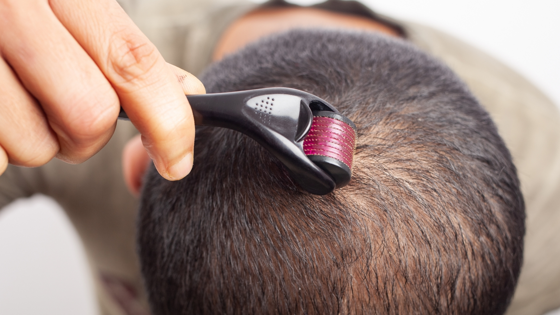 Microneedling Scalp