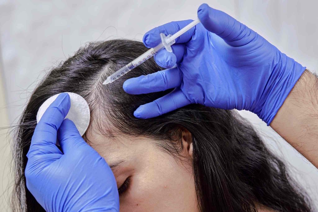 Microneedling Works for Hair Loss