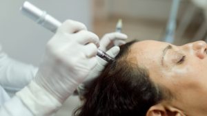 Microneedling for Hair Growth