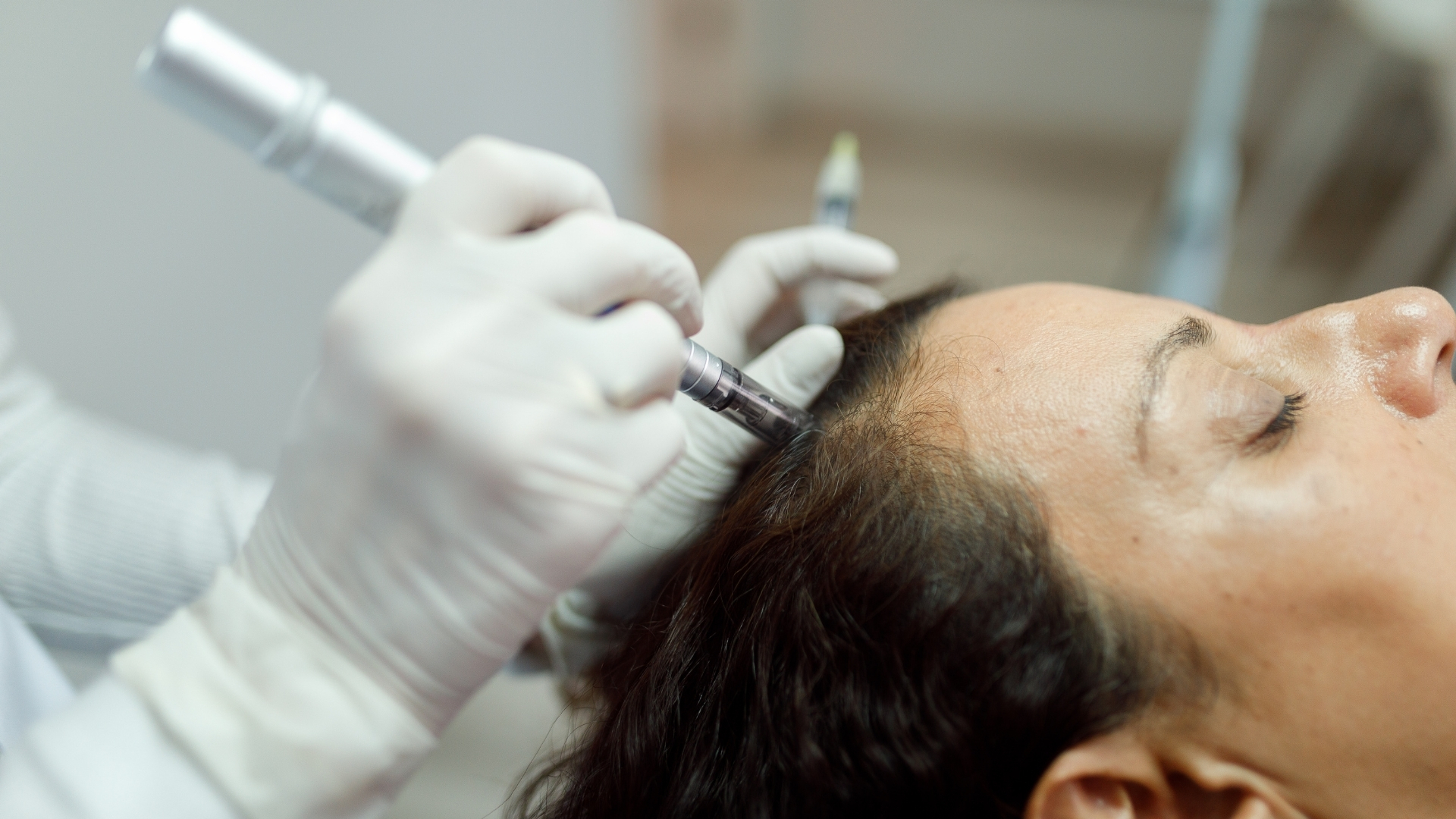 Microneedling for Hair Growth