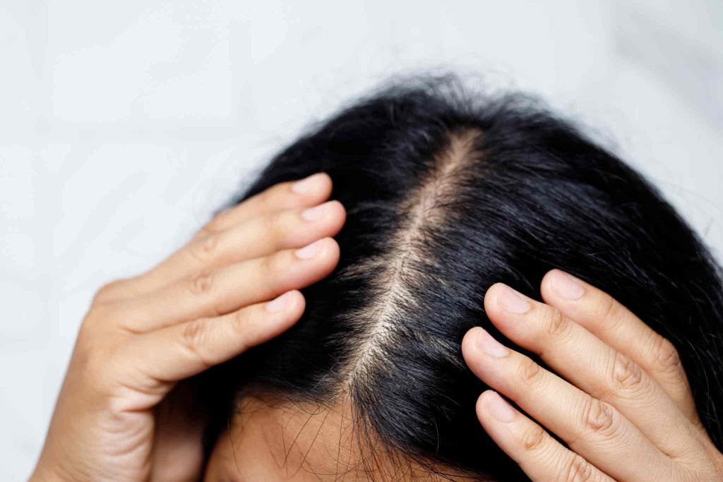 Microneedle scalp