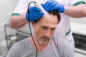 Microneedling for Hair Loss