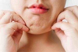 Women with fatty chin