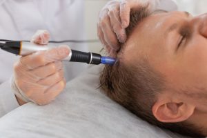 Scalp Microneedling