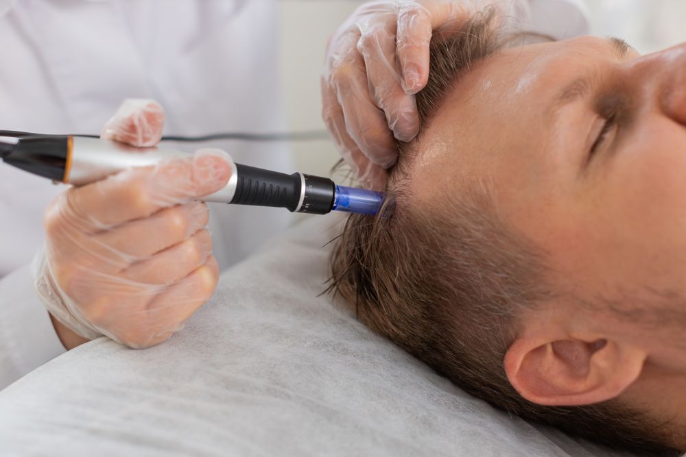Scalp Microneedling