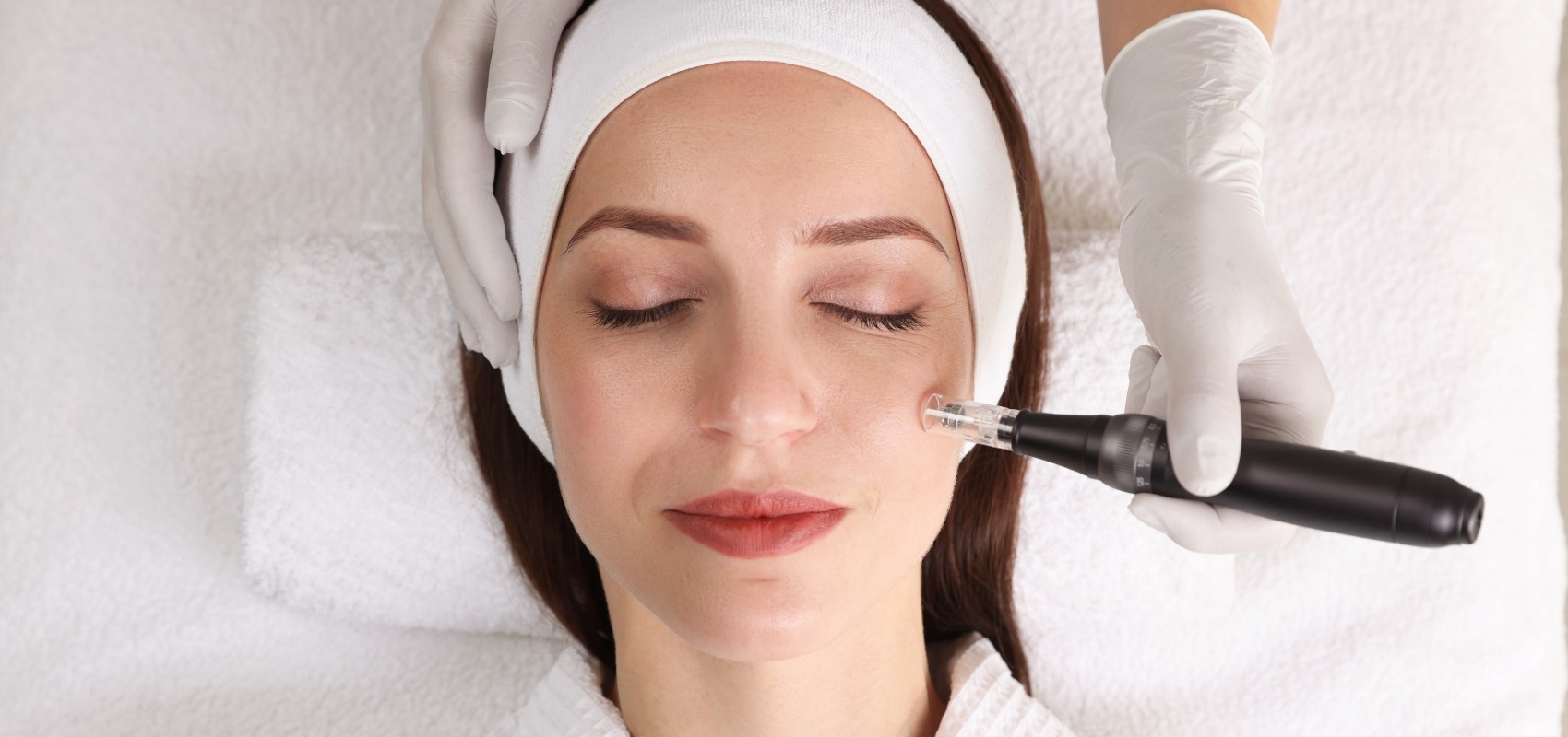 patient receiving a professional microneedling treatment