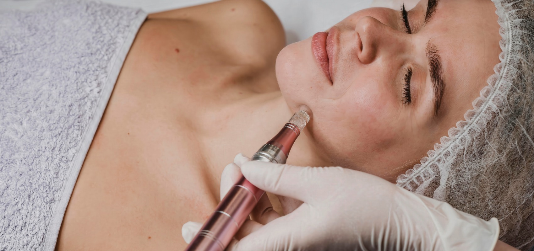 performing microneedling on a patient